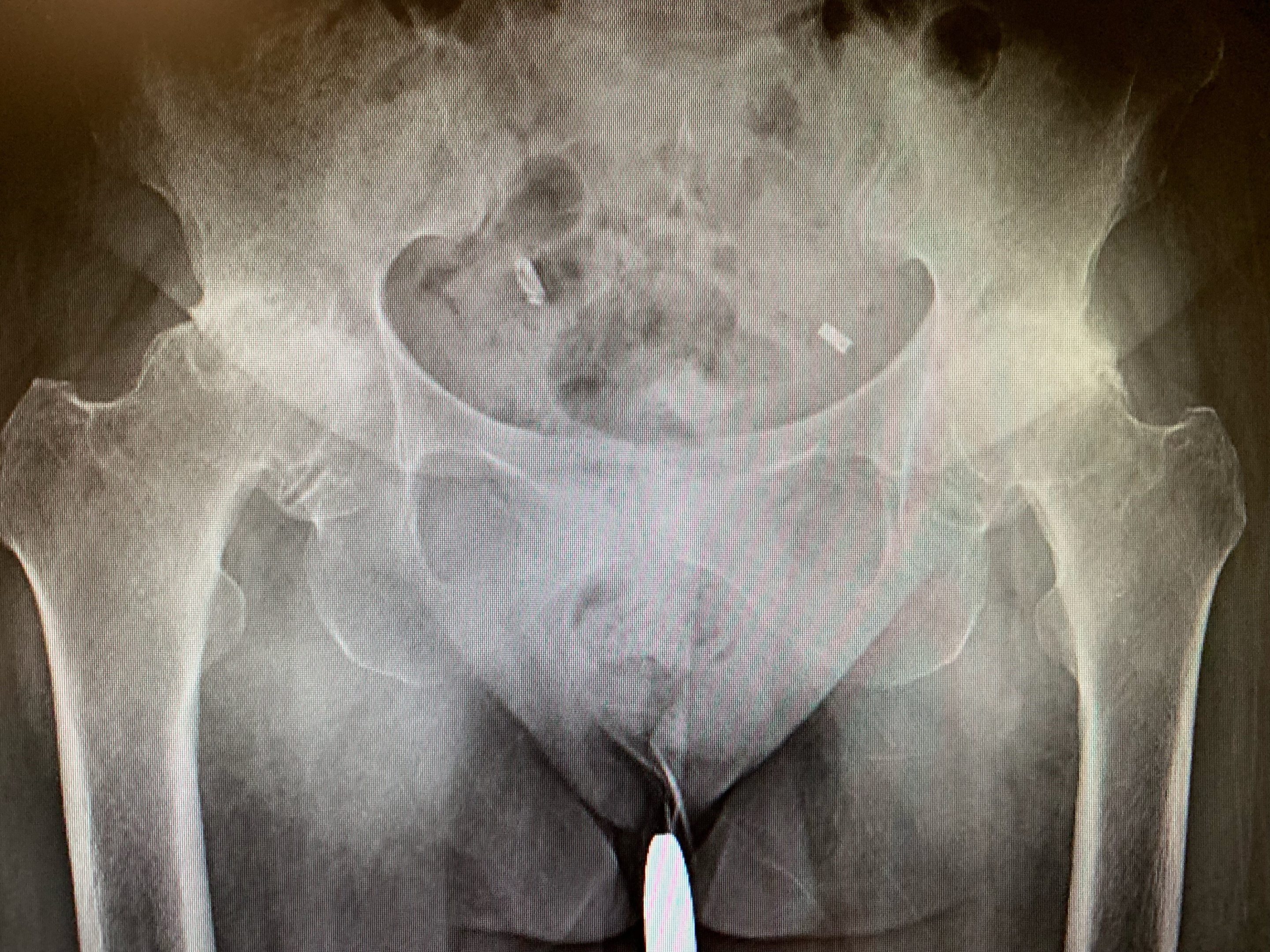 Bilateral hip replacement in 66 year old femalea