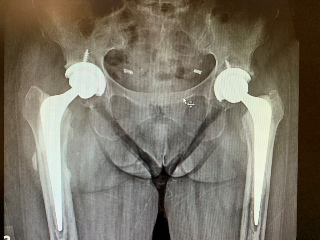 Case Study Bilateral hip replacement in 66 year old female Complete