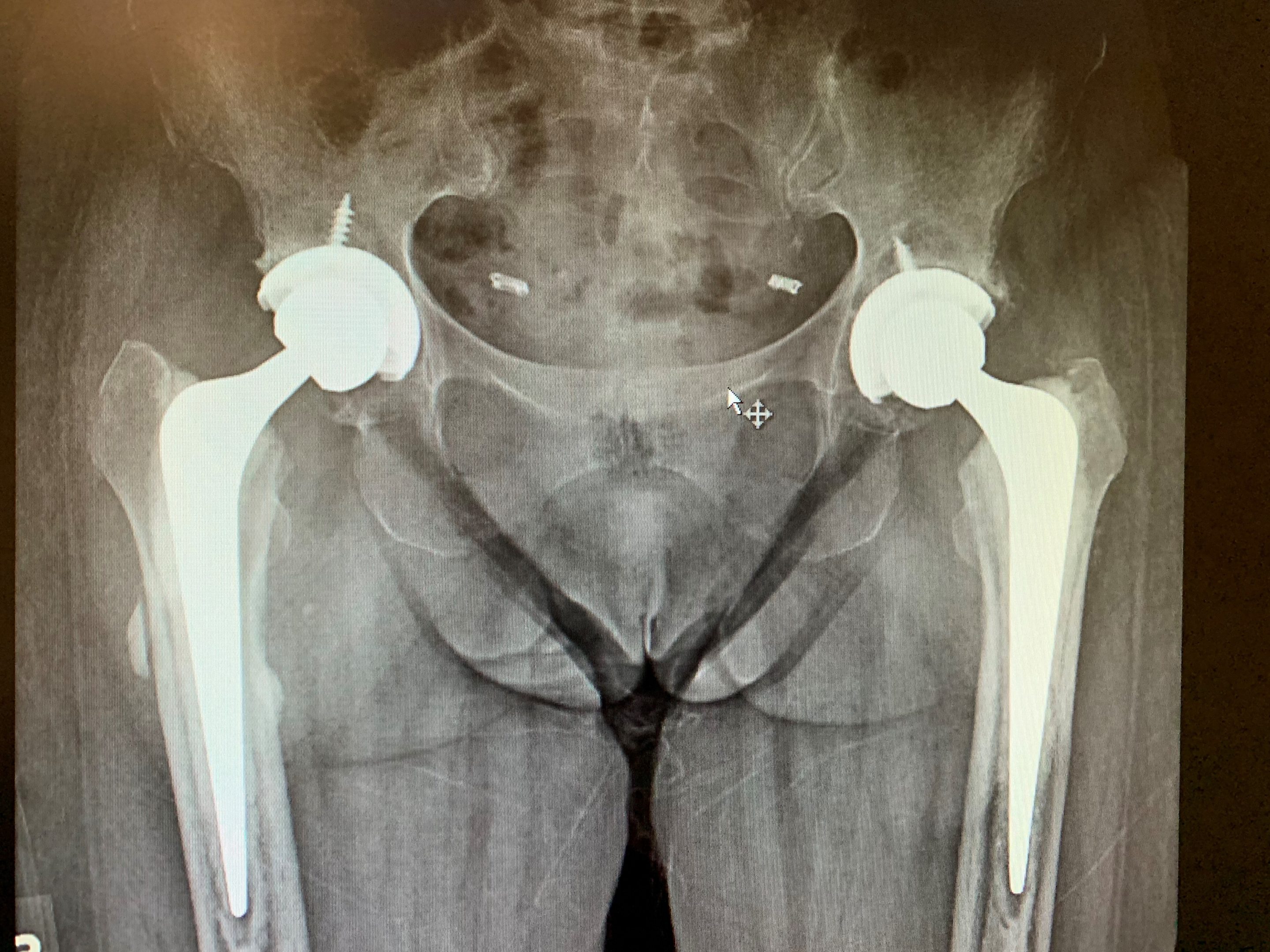 Bilateral hip replacement in 66 year old femaleb