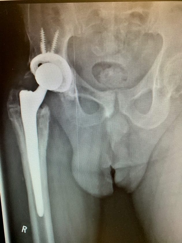 Complex Hip replacement – Implant removal with total hip replacementb