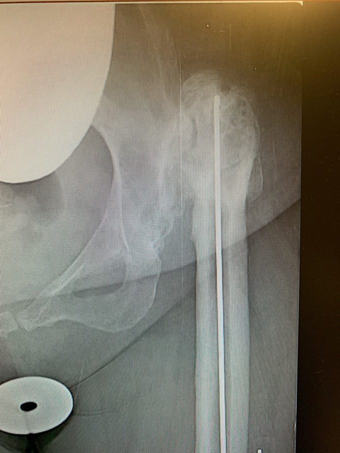 Complex hip replacement for hip Dysplasiaa