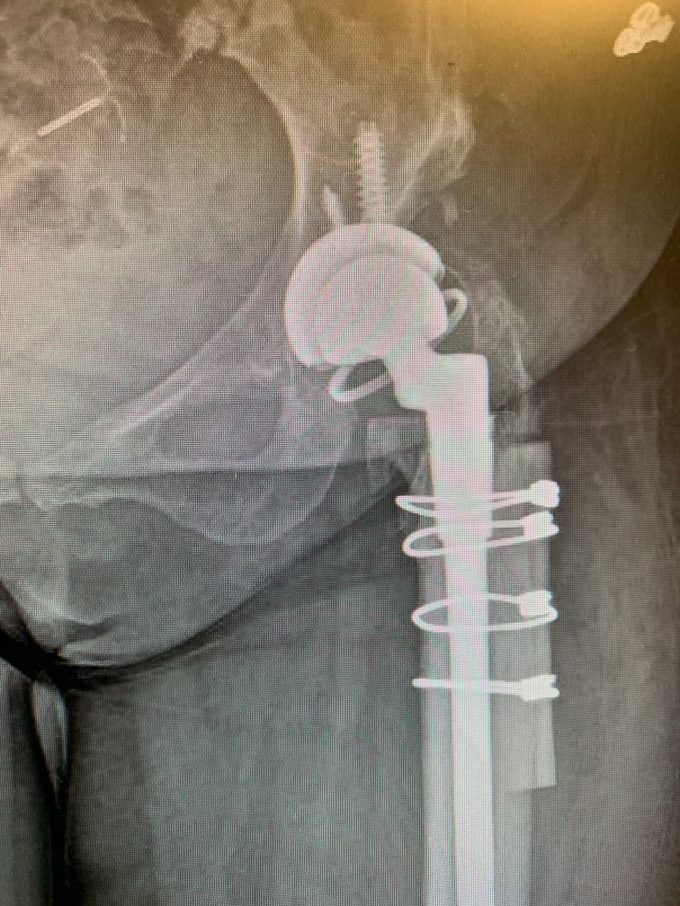 Complex hip replacement for hip Dysplasiab