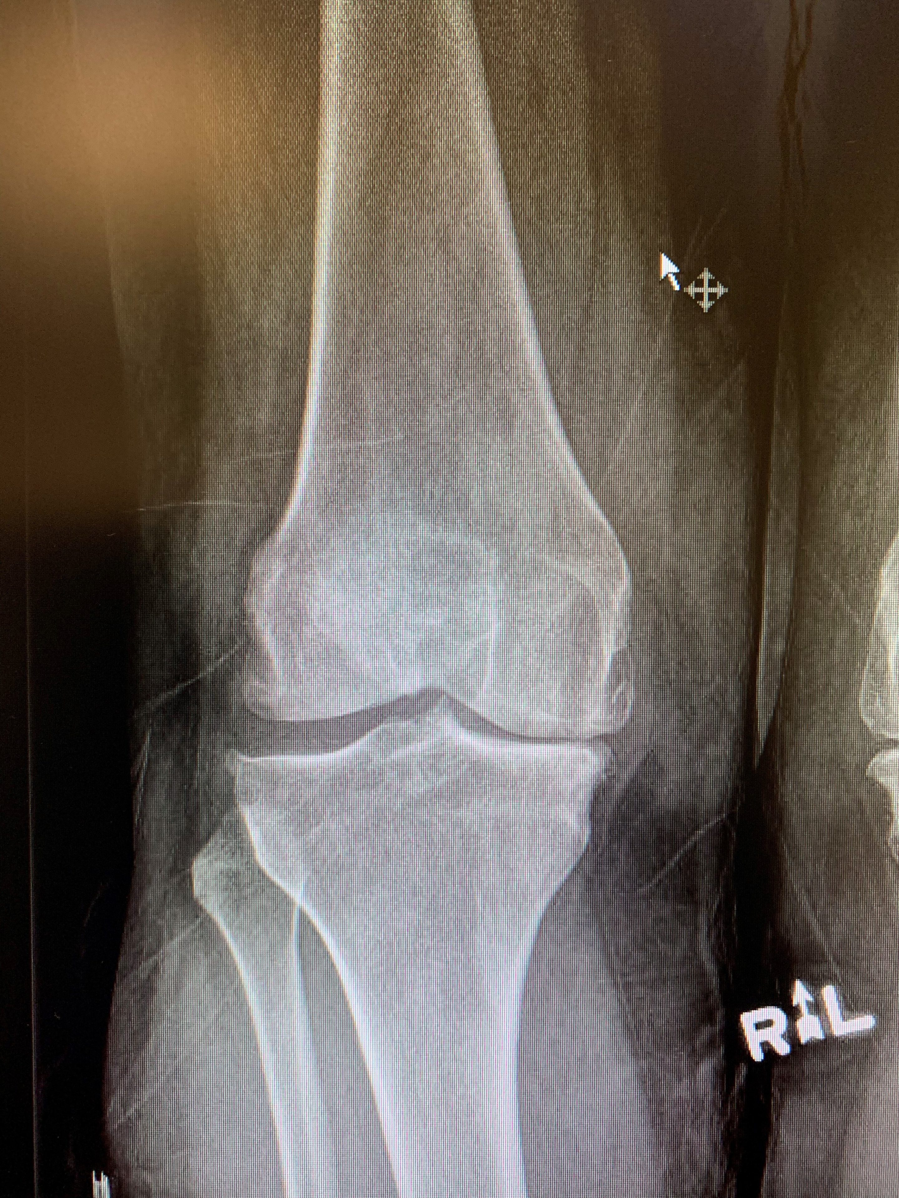Computer navigated Primary Knee replacementa
