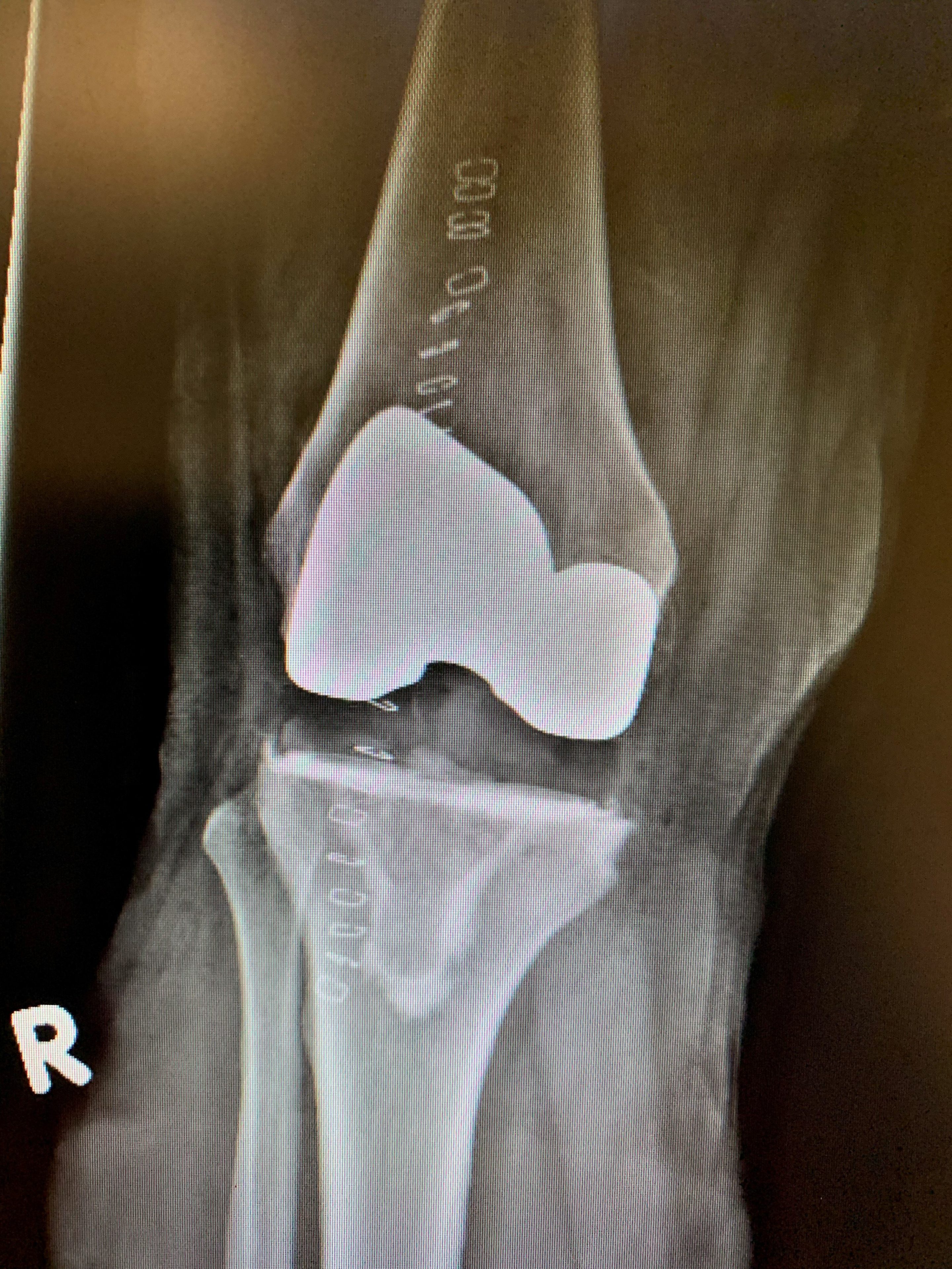 Computer navigated Primary Knee replacementb