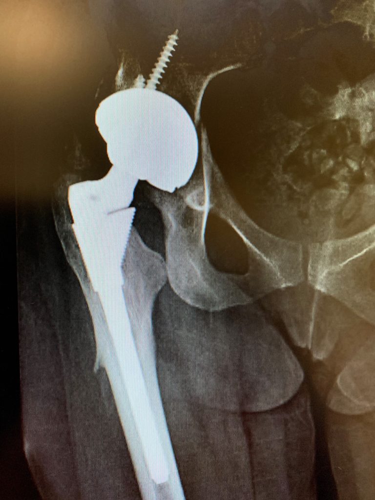Hip dislocation treatment – Acetabular component exchange in total hip replacementb