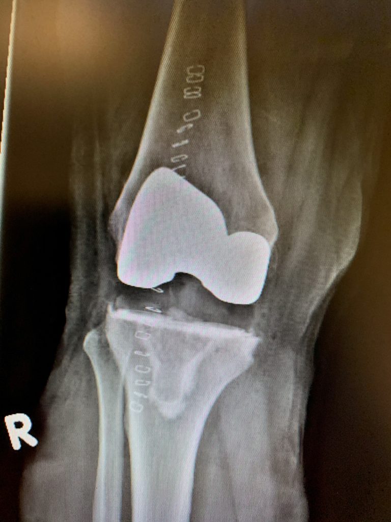Primary Knee replacement with custom instrumentation in a 63 year old maleb