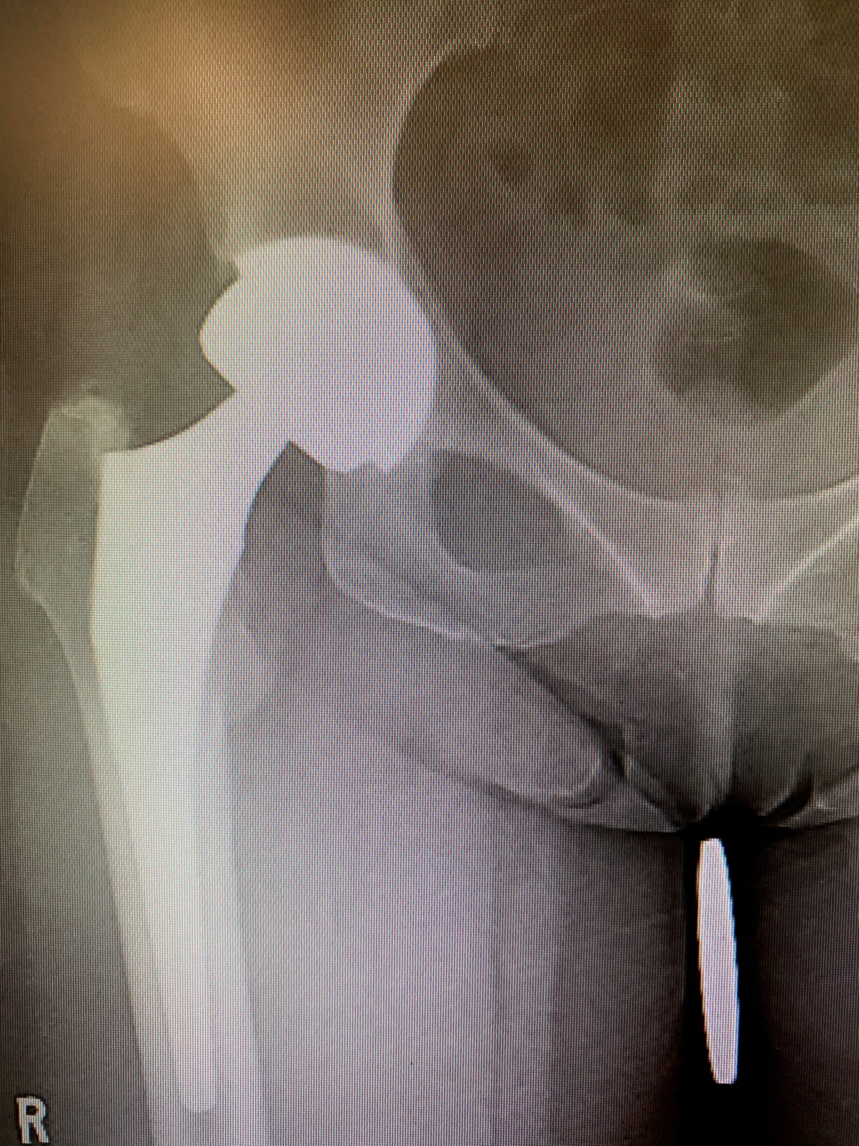 Revision Total Hip Replacement in a 64year old. Isolated acetabular component exchangea