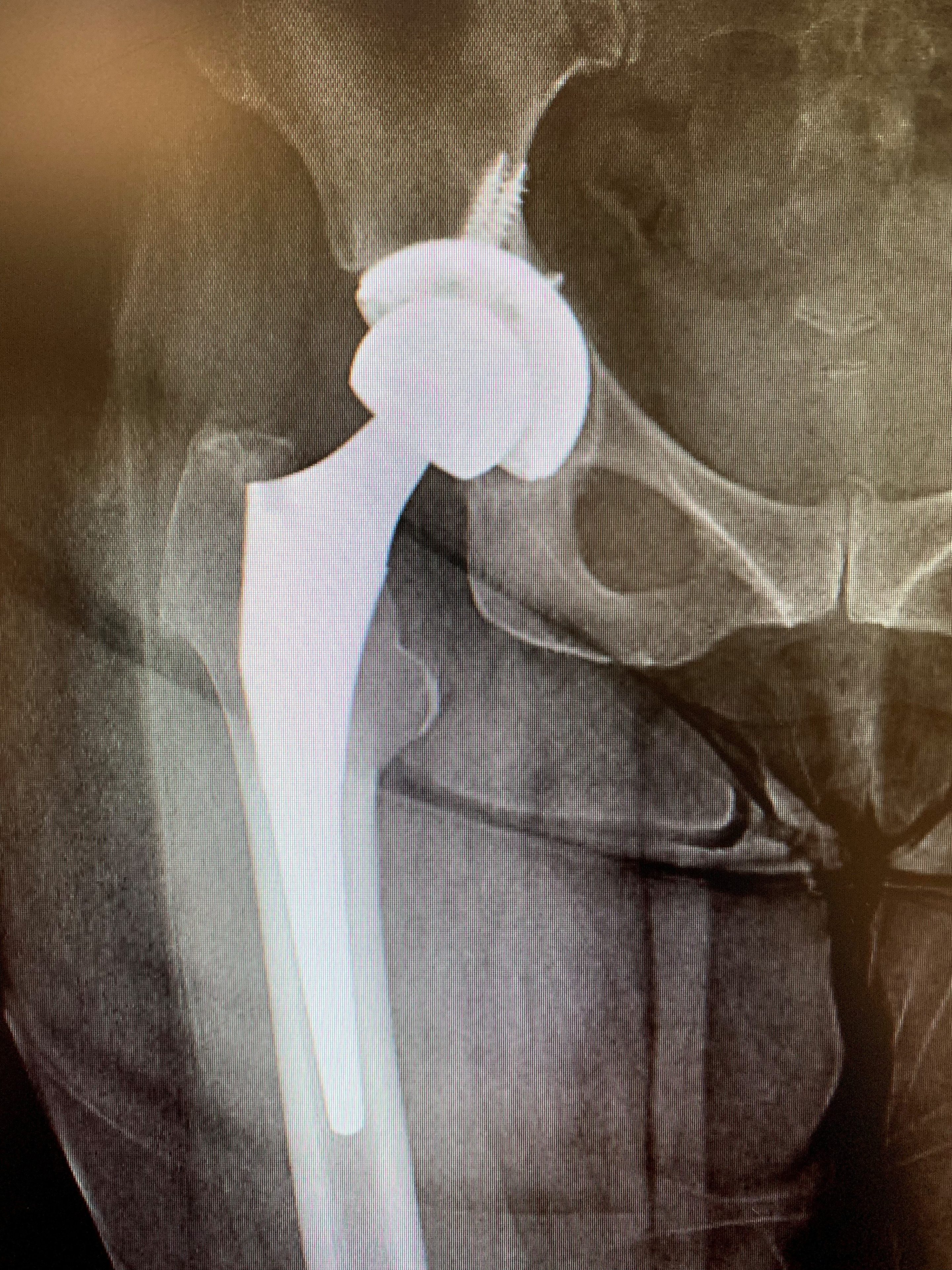 Revision Total Hip Replacement in a 64year old. Isolated acetabular component exchangeb