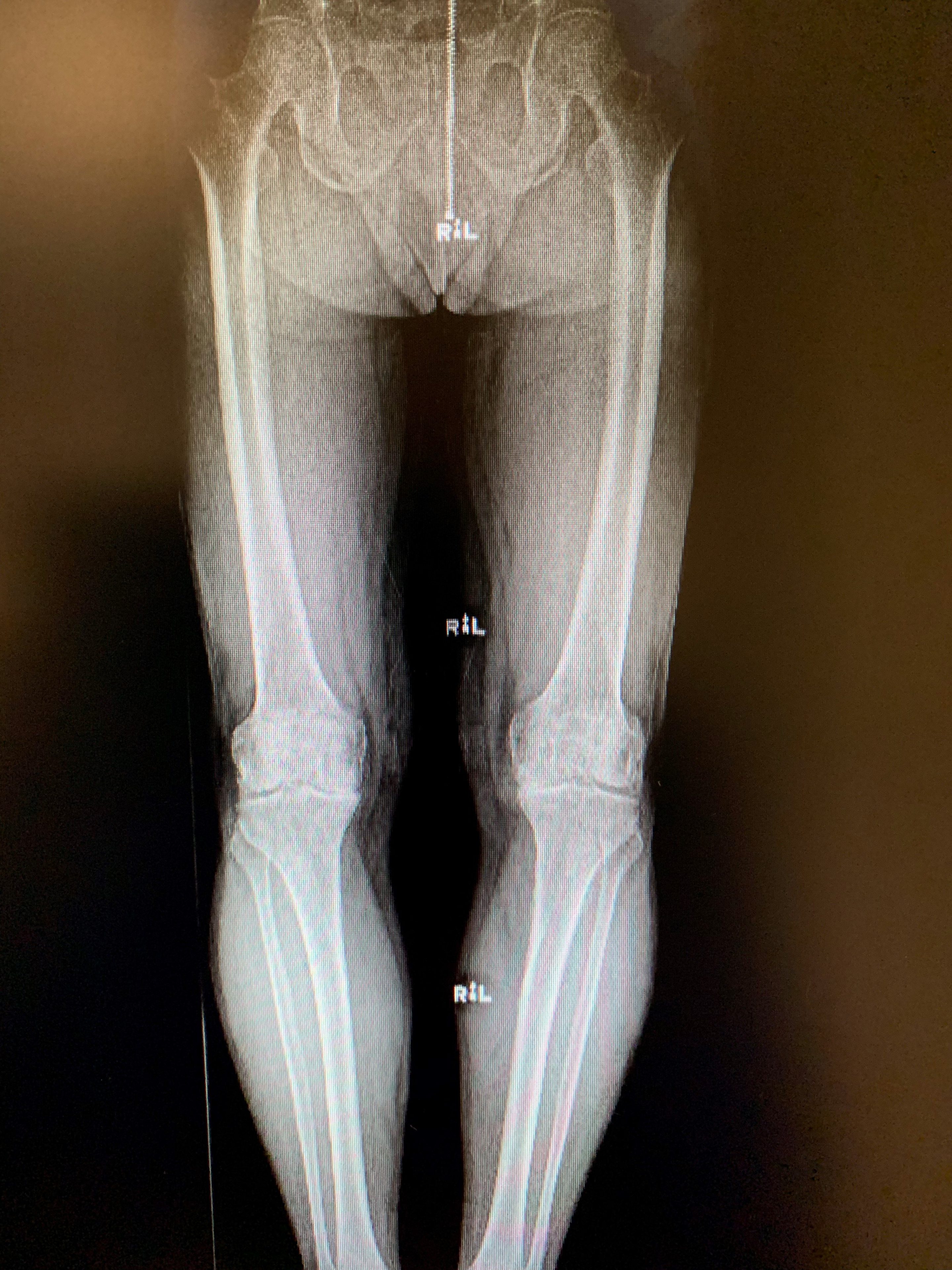 Reemplazo bilateral simultáneo de rodilla unicondilar en malea de 67 años