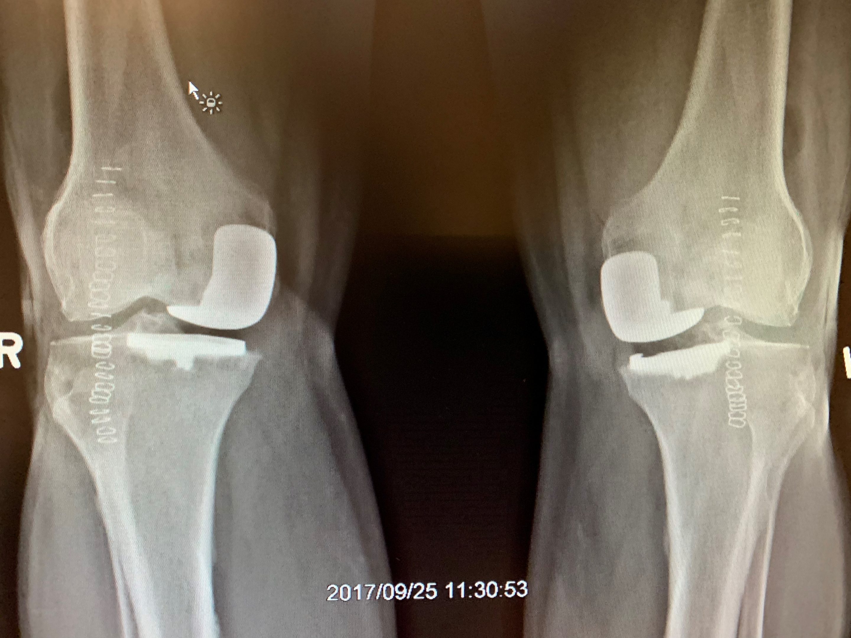 Simultaneous bilateral Unicondylar Knee replacement in 67 year old maleb