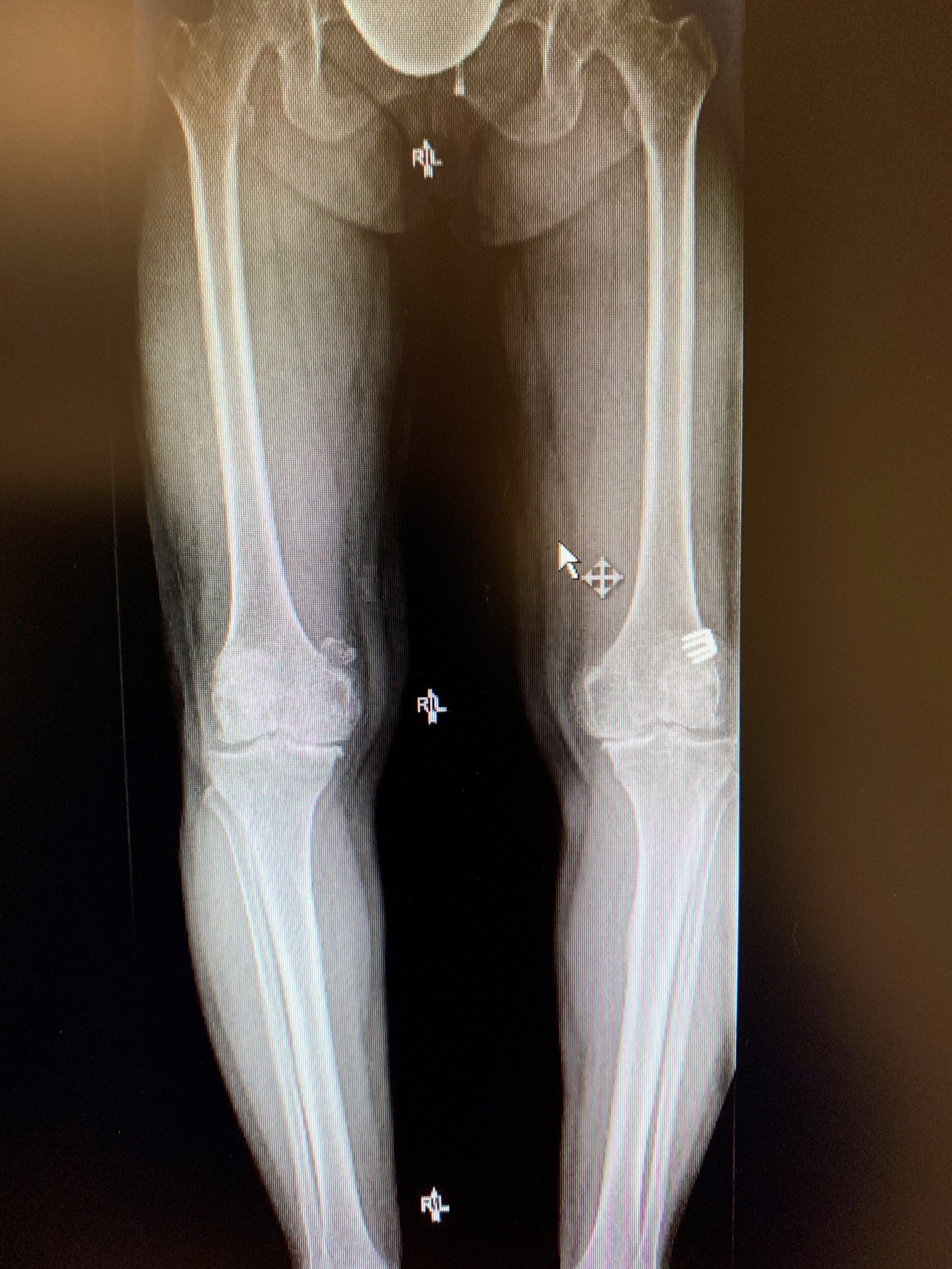 Simultaneous bilateral knee replacement in a 54 year old femalea