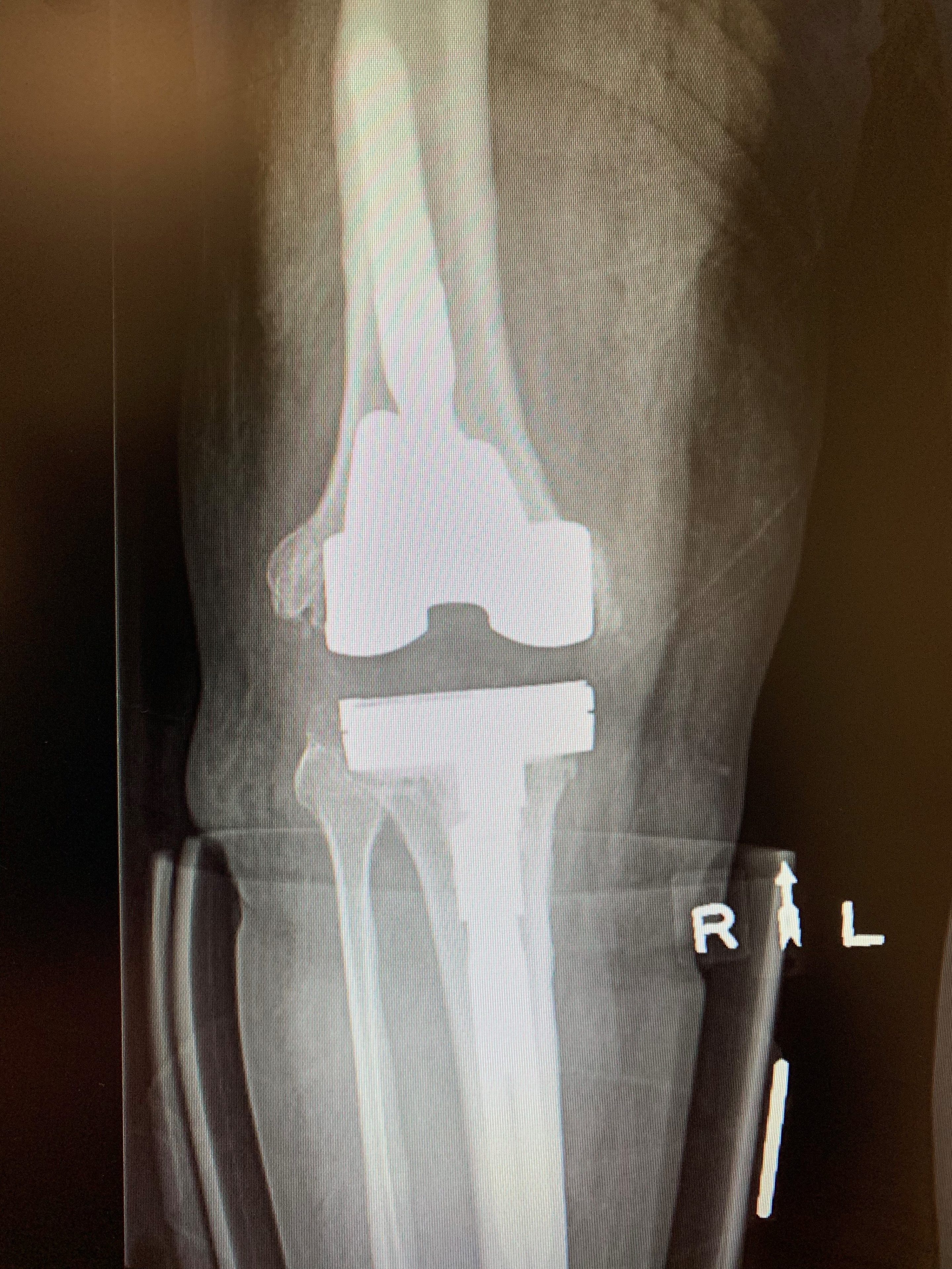 Treatment of infected knee replacement. A staged reconstruction in a 64 year old malea