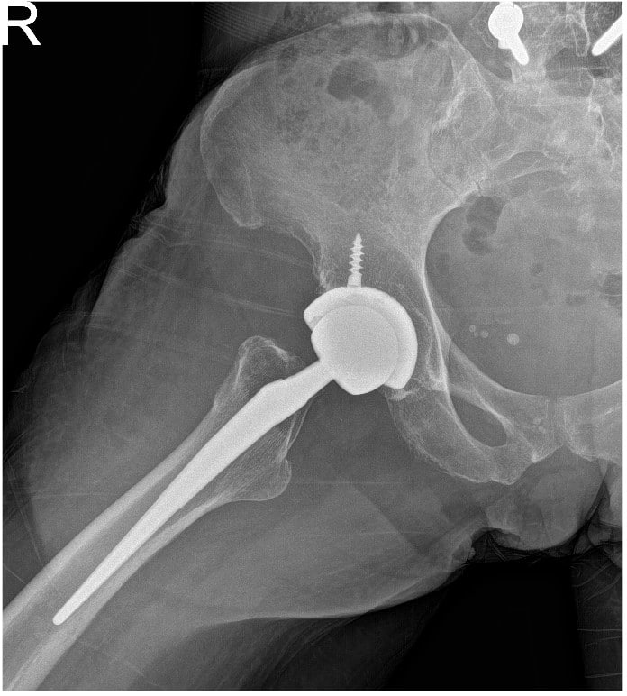 Post operative view xray of the hip