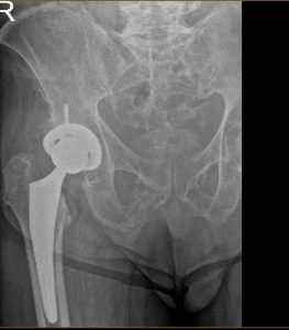 Xray of a hip replacement