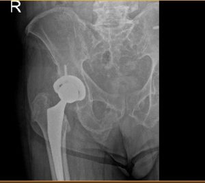 Radiografía de cadera postoperatoria