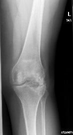 X-ray showing AP and Lateral views of the left knee post removal of the lateral plateau plate