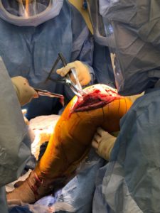 Complete orthopedic surgeons in the operating room working on a knee