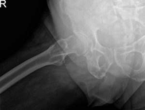 Imágenes radiográficas preoperatorias que muestran AP y vista lateral de la cadera derecha con pata de rana