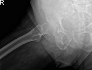 Preoperative X-ray images showing AP and frog-leg lateral view of the right hip