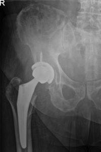 Radiografía postoperatoria que muestra AP y vistas laterales de la cadera derecha con pata de rana