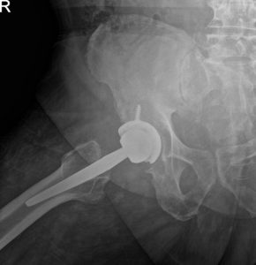 Radiografía postoperatoria que muestra AP y vistas laterales de la cadera derecha con pata de rana