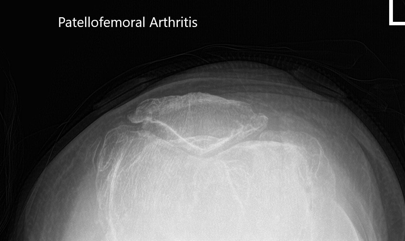 Preoperative merchant views of the bilateral patella showing severe osteoarthritis of the patellofemoral compartment