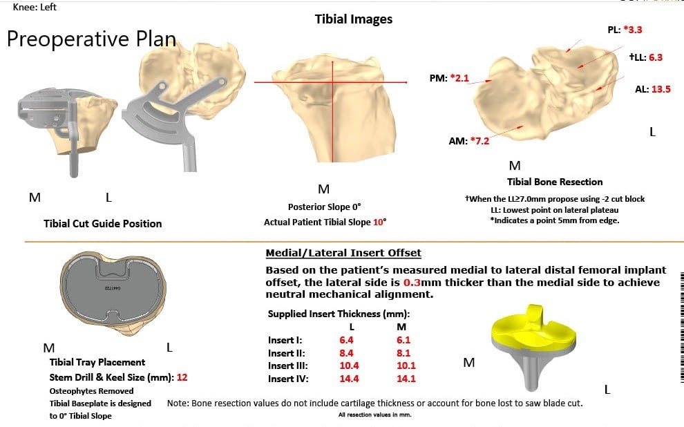 A patient specific surgical plan for a patient at Complete Orthopedics in New York - scan 3