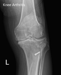 Radiografía preoperatoria de la rodilla izquierda que muestra AP y vistas laterales con cambios osteoartríticos degenerativos y hardware retenido en la tibia proximal