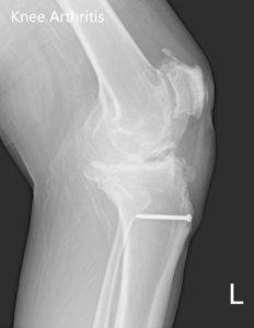 Preoperative X-ray of the left knee showing AP and lateral views with degenerative osteoarthritic changes and retained hardware in the proximal tibia - img 2