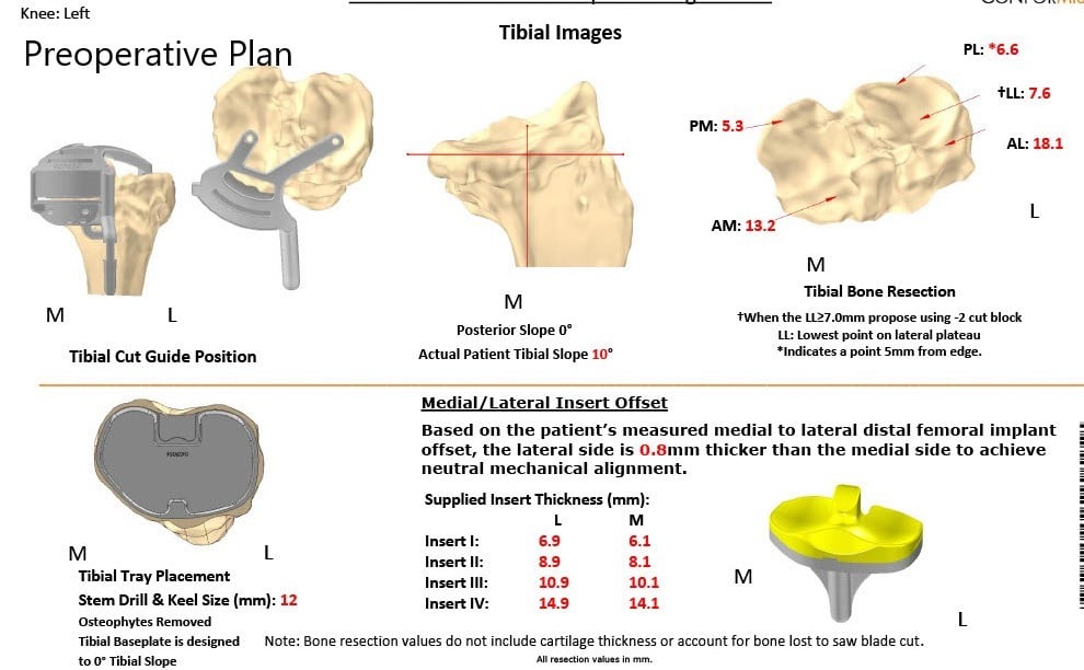 Complete Orthopedics patient specific surgical plan for a Custom Left Knee Replacement in a 59-year-old female