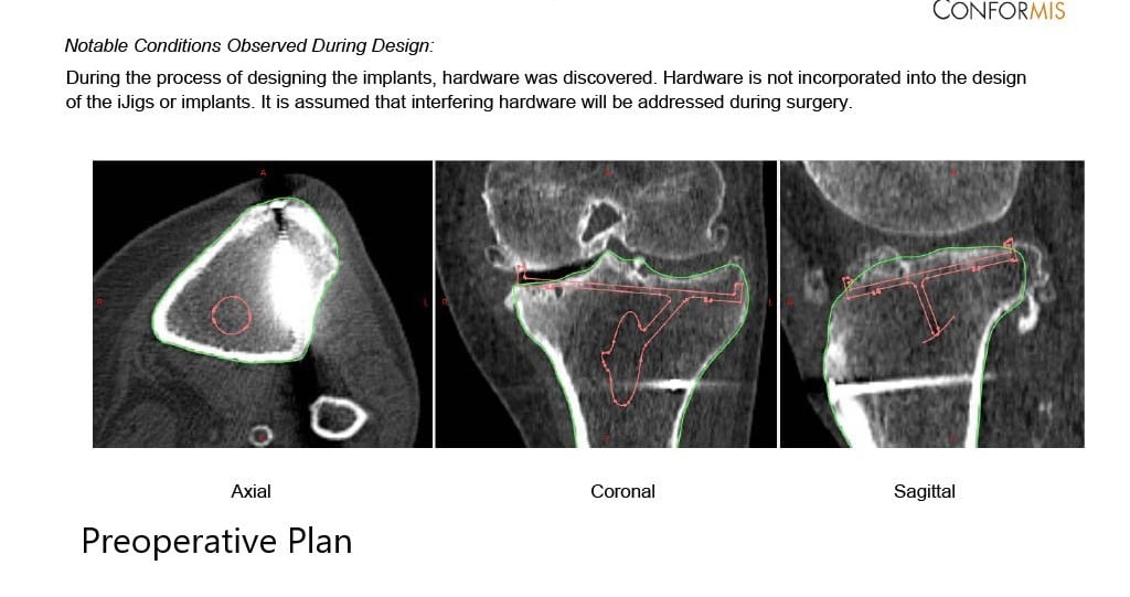 Complete Orthopedics patient specific surgical plan for a Custom Left Knee Replacement in a 59-year-old female - scan 3