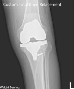 Radiografía postoperatoria de la rodilla izquierda que muestra AP y vistas laterales