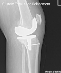 Postoperative X-ray of the left knee showing AP and lateral views - img 2