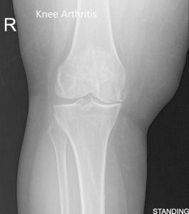 Vistas preoperatorias de AP y radiografía lateral de la rodilla derecha