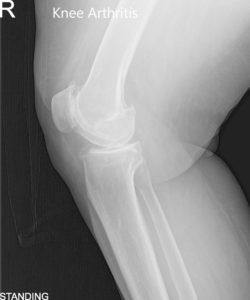 Vistas preoperatorias de AP y radiografía lateral de la rodilla derecha - img 2