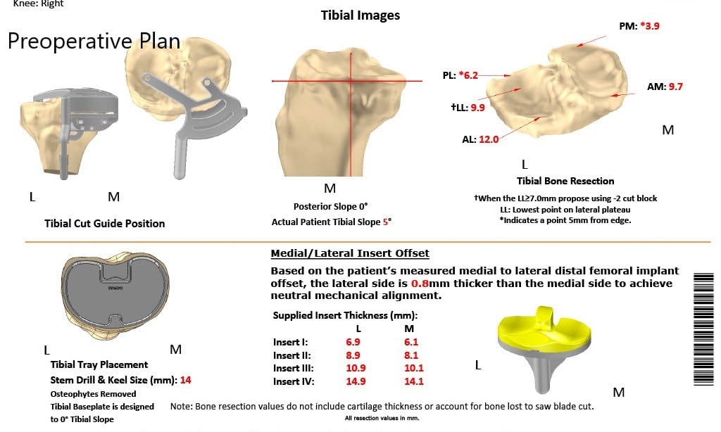 Plan quirúrgico completo específico para pacientes de Ortopedia para un reemplazo unilateral de rodilla personalizado en una mujer de 74 años
