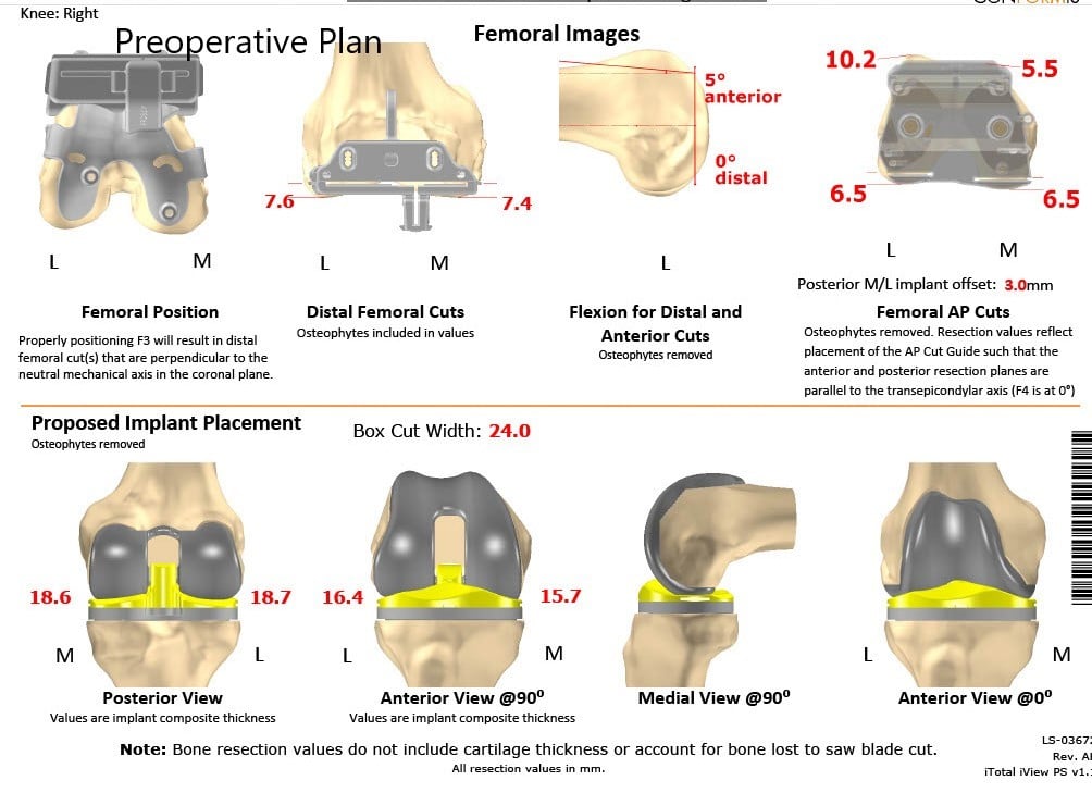 Complete Orthopedics patient specific surgical plan for a Custom Unilateral Knee Replacement in a 74-year-old Female - scan 2