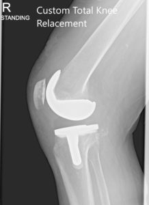 Radiografía postoperatoria de la rodilla derecha del paciente que muestra AP y vistas laterales - img 2
