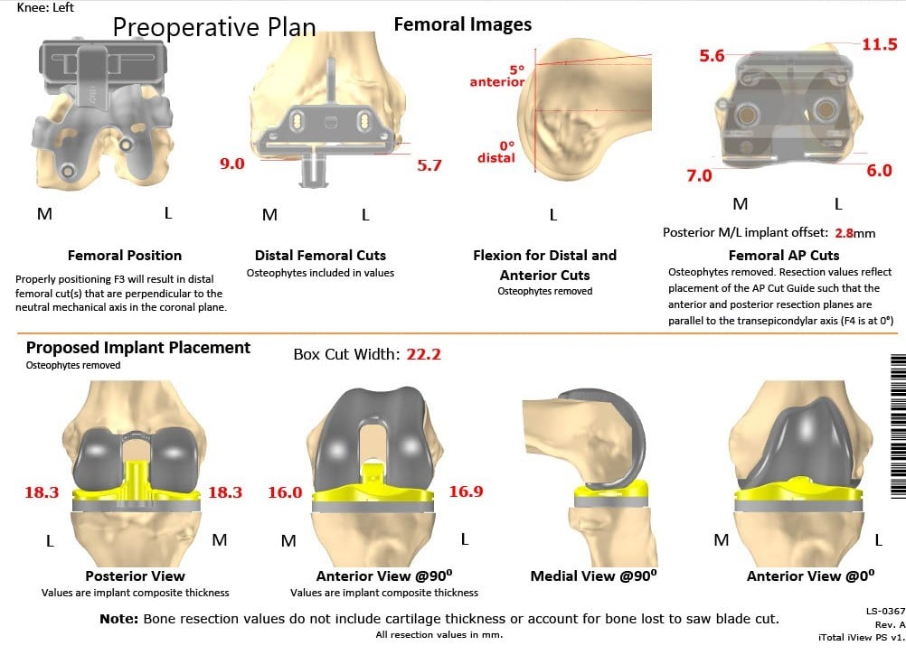 Complete Orthopedics patient specific surgical plan for a Customized Left Knee Replacement in an 81-year-old patient - scan 2