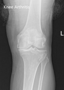Preoperative X-ray images showing AP and lateral images of the left knee revealing tricompartmental osteoarthritis and severe medial joint space reduction