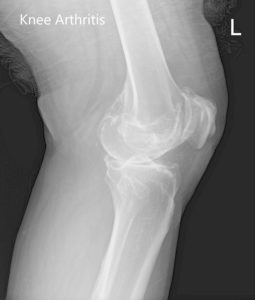 Preoperative X-ray images showing AP and lateral images of the left knee revealing tricompartmental osteoarthritis and severe medial joint space reduction - img 2