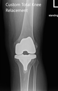 Postoperative X-ray images of the left knee in AP and lateral view