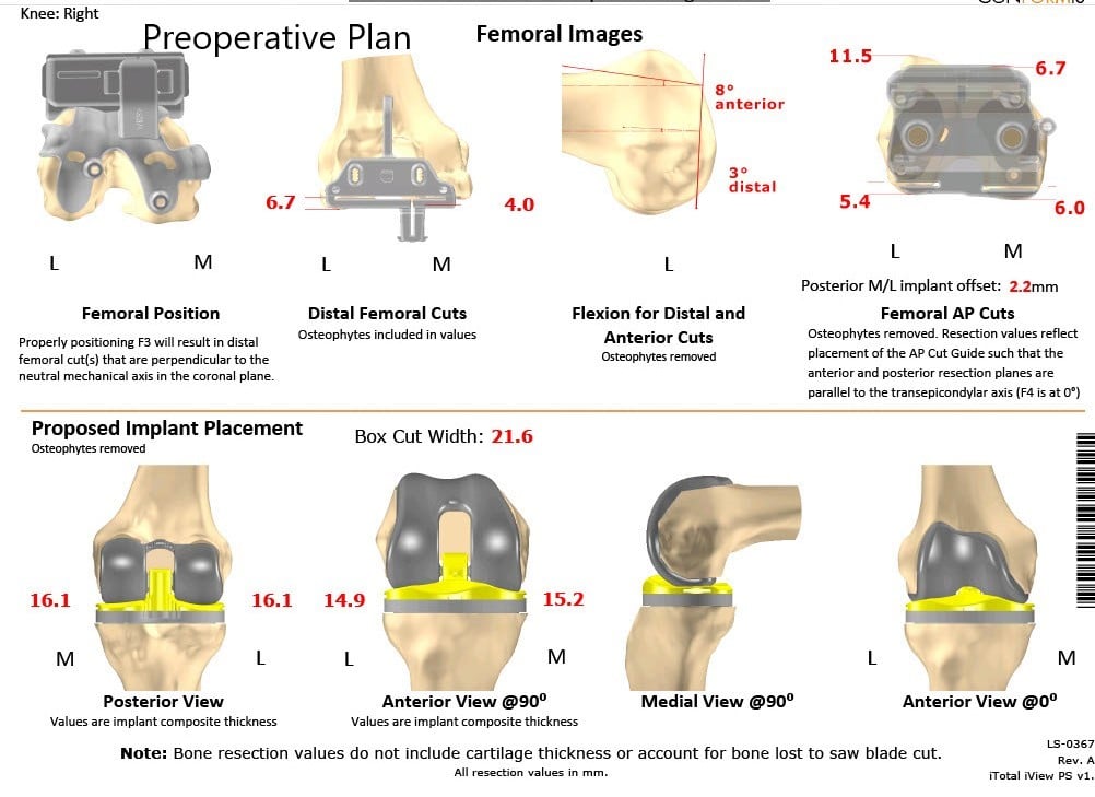Complete Orthopedics patient specific surgical plan for a Customized Right Knee Replacement in a 71-year-old patient - scan 2