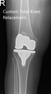 Postoperative X-ray of the right knee showing AP and Oblique views