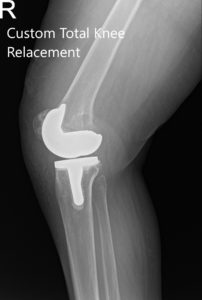 Postoperative X-ray of the right knee showing AP and Oblique views - img 2