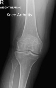 Preoperative weight-bearing X-ray showing AP and lateral views of the right knee
