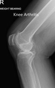 Preoperative weight-bearing X-ray showing AP and lateral views of the right knee - img 2