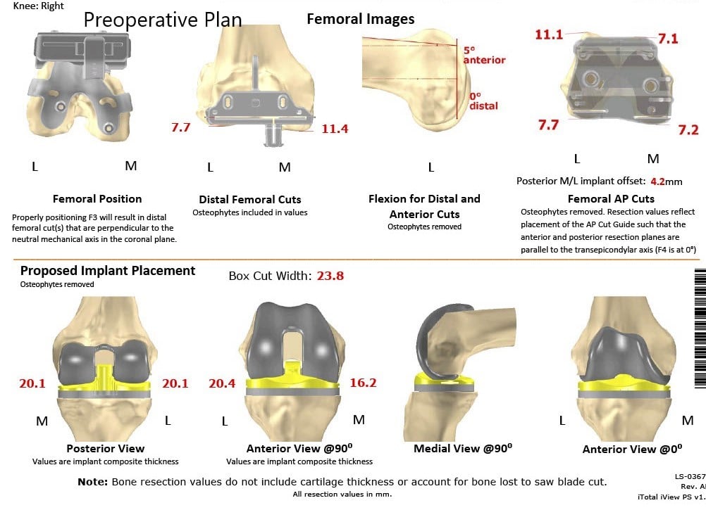 Complete Orthopedics patient specific surgical plan for a Customized Total Knee Replacement in a 58-year-old female with Arthritis - scan 2