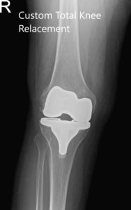 Postoperative X-ray of the patient showing AP and lateral views of the right knee