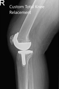 Postoperative X-ray of the patient showing AP and lateral views of the right knee - img 2